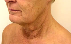 facelift before photo by michigan cosmetic surgery in southfield mi