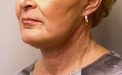 facelift after photo by michigan cosmetic surgery in southfield mi