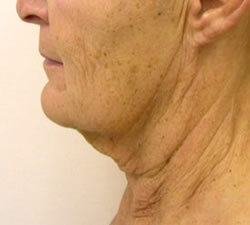 facelift before photo by michigan cosmetic surgery in southfield mi