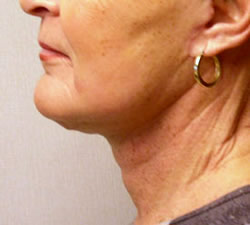 facelift after photo by michigan cosmetic surgery in southfield mi