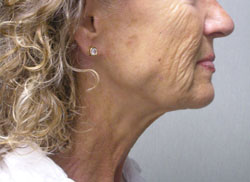 facelift before photo by michigan cosmetic surgery in southfield mi