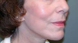 facelift after photo by michigan cosmetic surgery in southfield mi