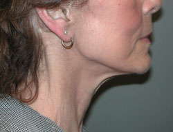 facelift before photo by michigan cosmetic surgery in southfield mi