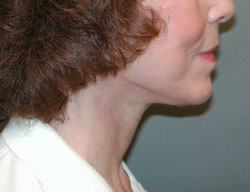 facelift after photo by michigan cosmetic surgery in southfield mi