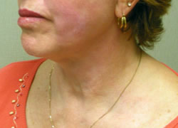 facelift after photo by michigan cosmetic surgery in southfield mi