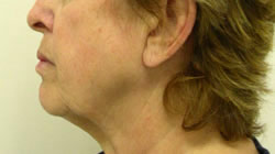 facelift before photo by michigan cosmetic surgery in southfield mi