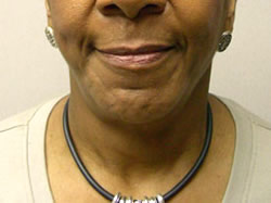 facelift after photo by michigan cosmetic surgery in southfield mi