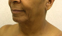 facelift before photo by michigan cosmetic surgery in southfield mi