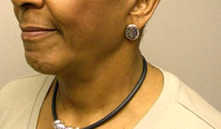 facelift after photo by michigan cosmetic surgery in southfield mi