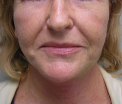 facelift after photo by michigan cosmetic surgery in southfield mi
