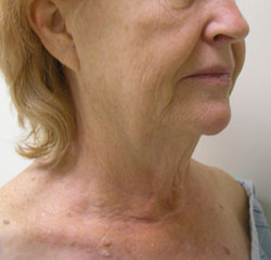 facelift before photo by michigan cosmetic surgery in southfield mi