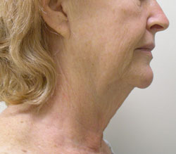 facelift before photo by michigan cosmetic surgery in southfield mi