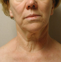 facelift before photo by michigan cosmetic surgery in southfield mi