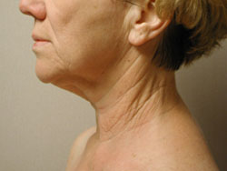 facelift before photo by michigan cosmetic surgery in southfield mi
