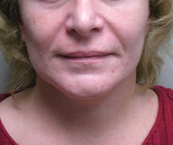 facelift after photo by michigan cosmetic surgery in southfield mi