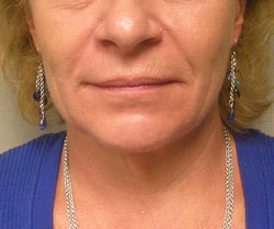 facelift before photo by michigan cosmetic surgery in southfield mi