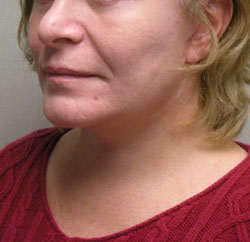 facelift after photo by michigan cosmetic surgery in southfield mi