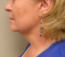 facelift before photo by michigan cosmetic surgery in southfield mi