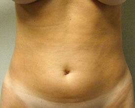 liposuction before photo by michigan cosmetic surgery in southfield mi