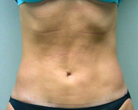 liposuction after photo by michigan cosmetic surgery in southfield mi