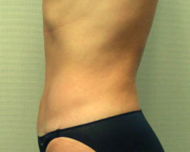liposuction after photo by michigan cosmetic surgery in southfield mi