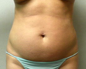 liposuction before photo by michigan cosmetic surgery in southfield mi