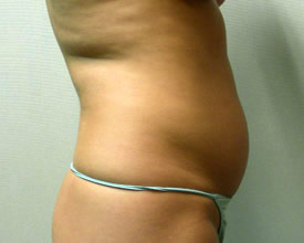 liposuction before photo by michigan cosmetic surgery in southfield mi