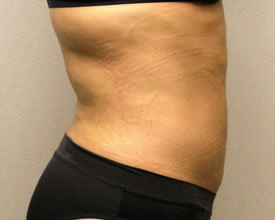 liposuction after photo by michigan cosmetic surgery in southfield mi