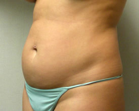 liposuction before photo by michigan cosmetic surgery in southfield mi
