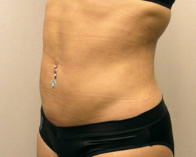 liposuction after photo by michigan cosmetic surgery in southfield mi