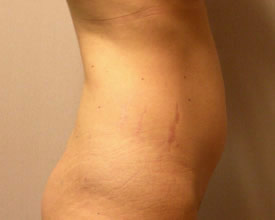 liposuction before photo by michigan cosmetic surgery in southfield mi