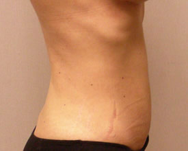liposuction after photo by michigan cosmetic surgery in southfield mi
