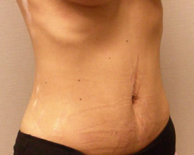 liposuction after photo by michigan cosmetic surgery in southfield mi