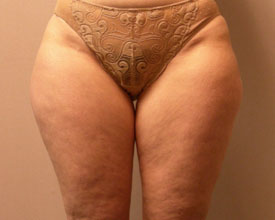 liposuction before photo by michigan cosmetic surgery in southfield mi