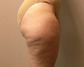 liposuction before photo by michigan cosmetic surgery in southfield mi