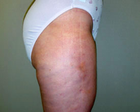 liposuction after photo by michigan cosmetic surgery in southfield mi
