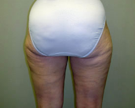 liposuction after photo by michigan cosmetic surgery in southfield mi