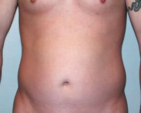 liposuction before photo by michigan cosmetic surgery in southfield mi