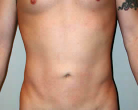 liposuction after photo by michigan cosmetic surgery in southfield mi