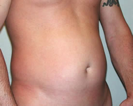 liposuction before photo by michigan cosmetic surgery in southfield mi