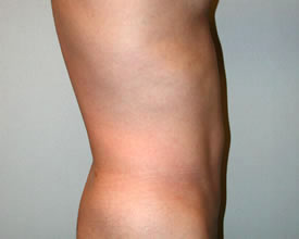 liposuction after photo by michigan cosmetic surgery in southfield mi