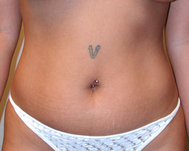 liposuction before photo by michigan cosmetic surgery in southfield mi