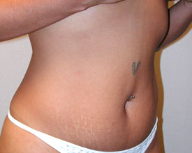 liposuction before photo by michigan cosmetic surgery in southfield mi