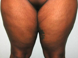 liposuction before photo by michigan cosmetic surgery in southfield mi