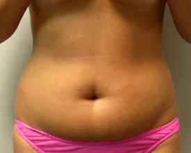 liposuction before photo by michigan cosmetic surgery in southfield mi