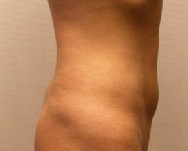 liposuction after photo by michigan cosmetic surgery in southfield mi