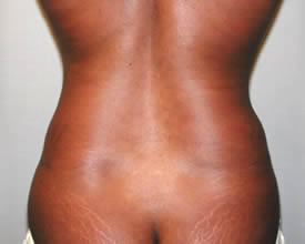 liposuction after photo by michigan cosmetic surgery in southfield mi