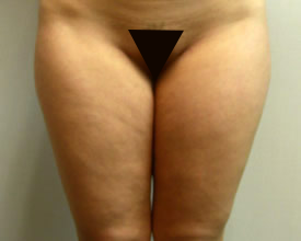 liposuction before photo by michigan cosmetic surgery in southfield mi