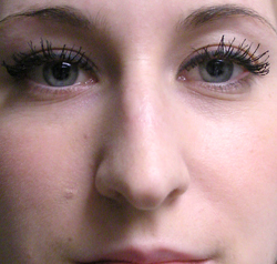 rhinoplasty before photo by michigan cosmetic surgery in southfield mi