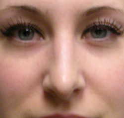 rhinoplasty after photo by michigan cosmetic surgery in southfield mi